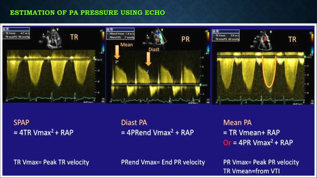 estimation of pa pressure using echo 2