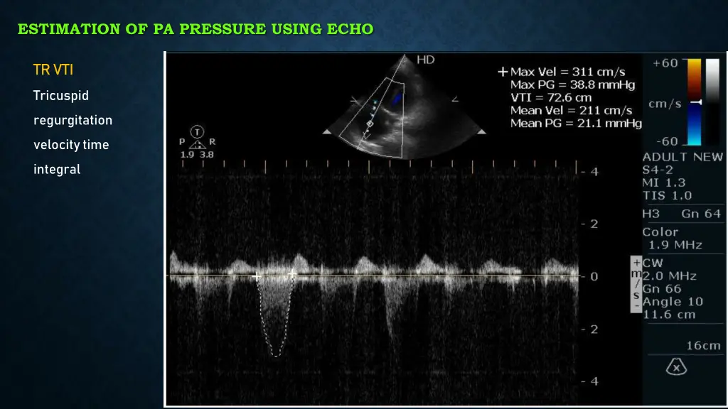 estimation of pa pressure using echo 4