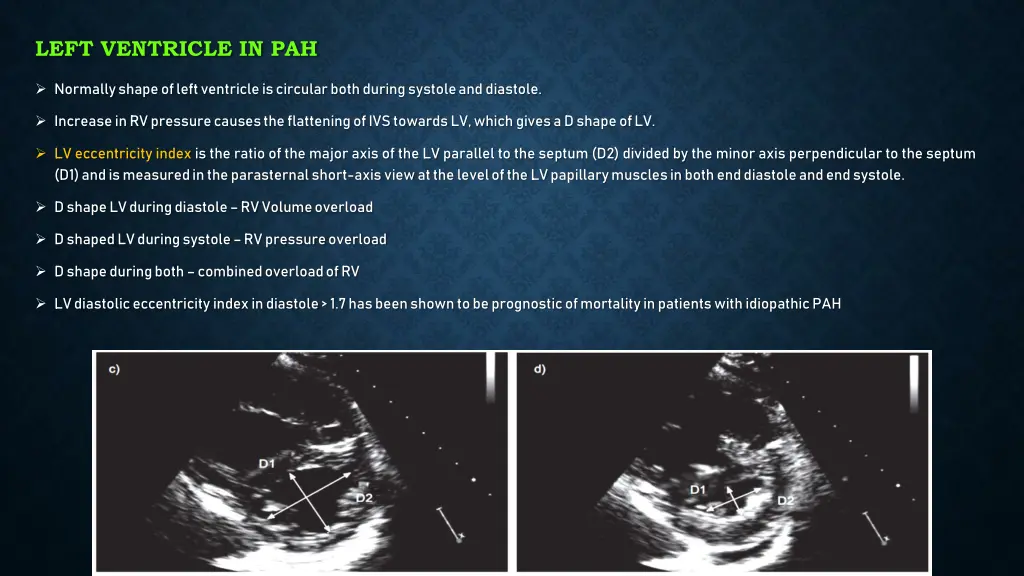 left ventricle in pah