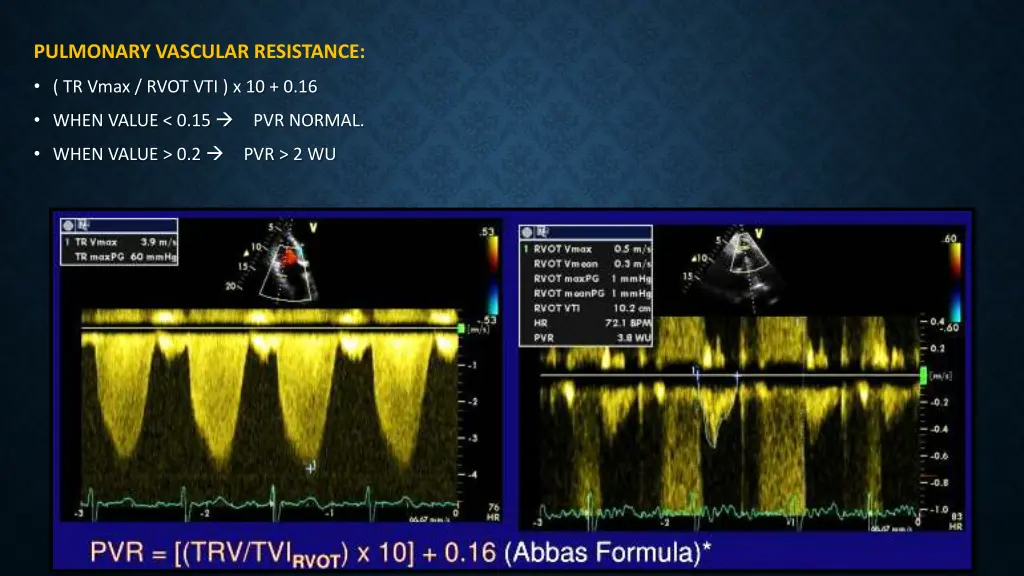 pulmonary vascular resistance