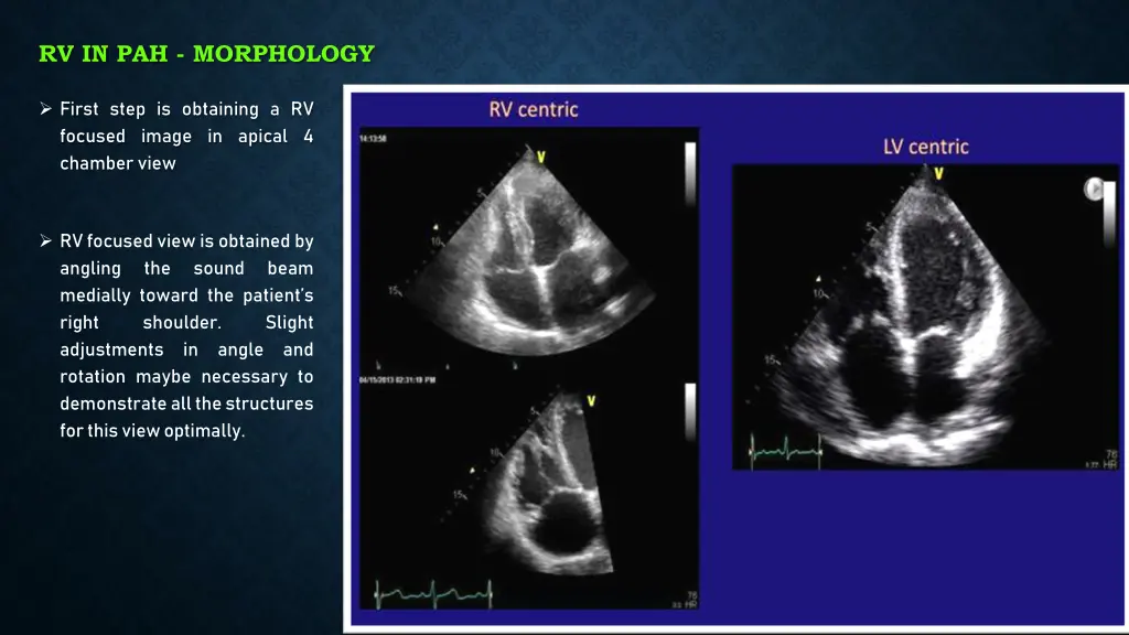 rv in pah morphology