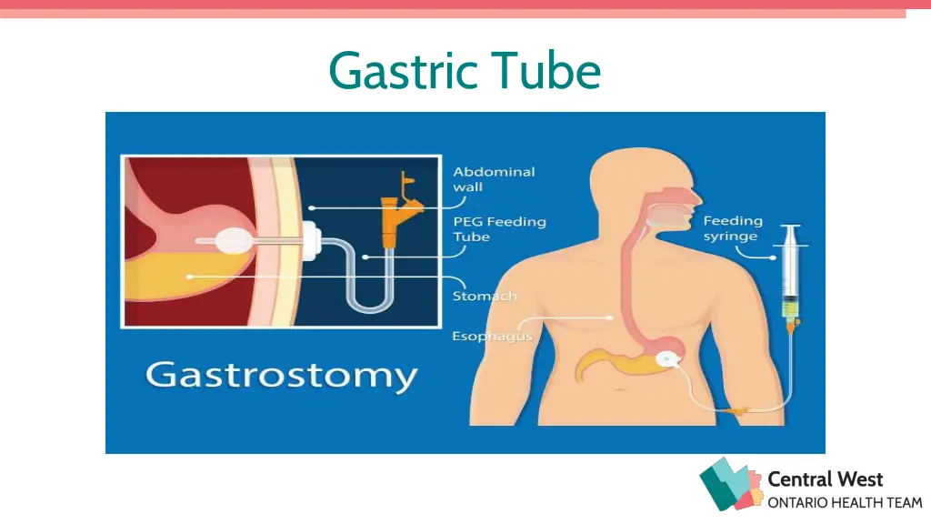 gastric tube
