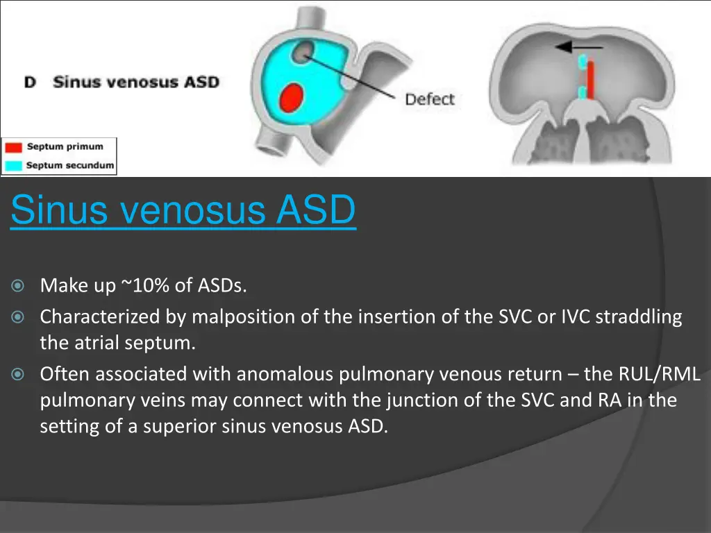 sinus venosus asd