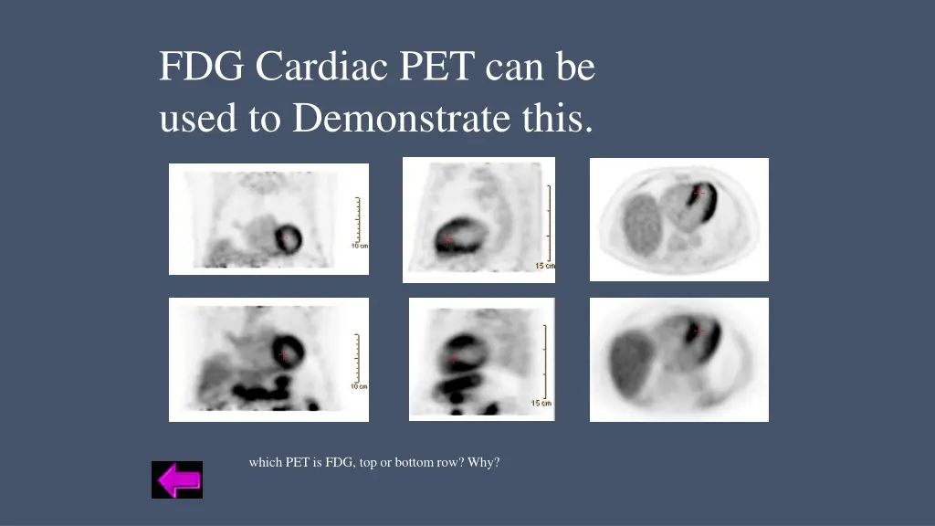 fdg cardiac pet can be used to demonstrate this