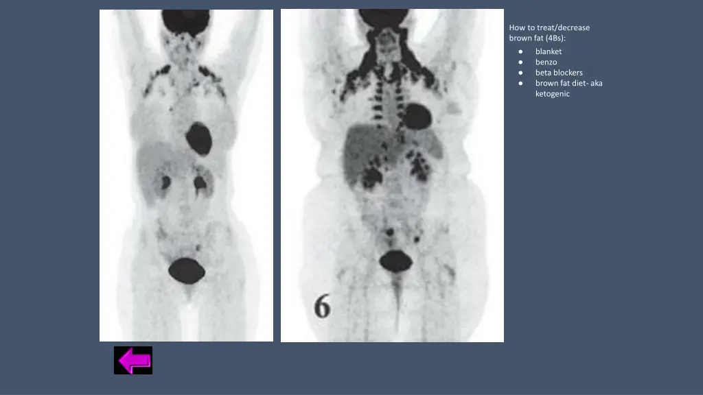 how to treat decrease brown fat 4bs