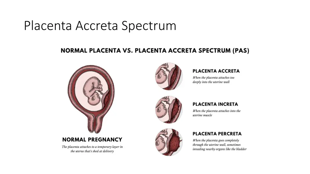 placenta accreta spectrum