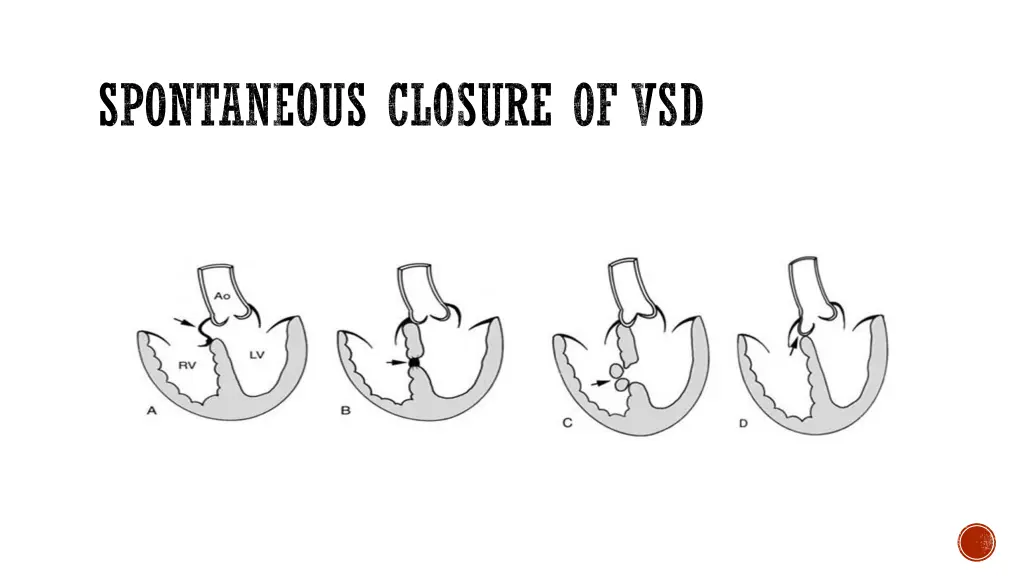 spontaneous closure of vsd
