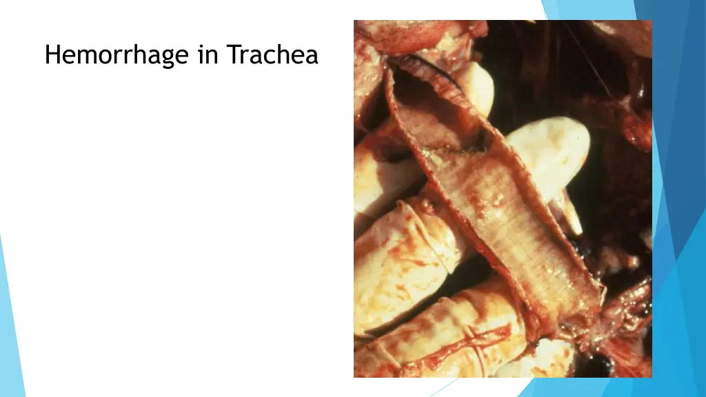 hemorrhage in trachea