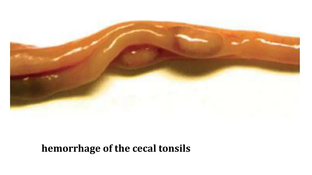 hemorrhage of the cecal tonsils