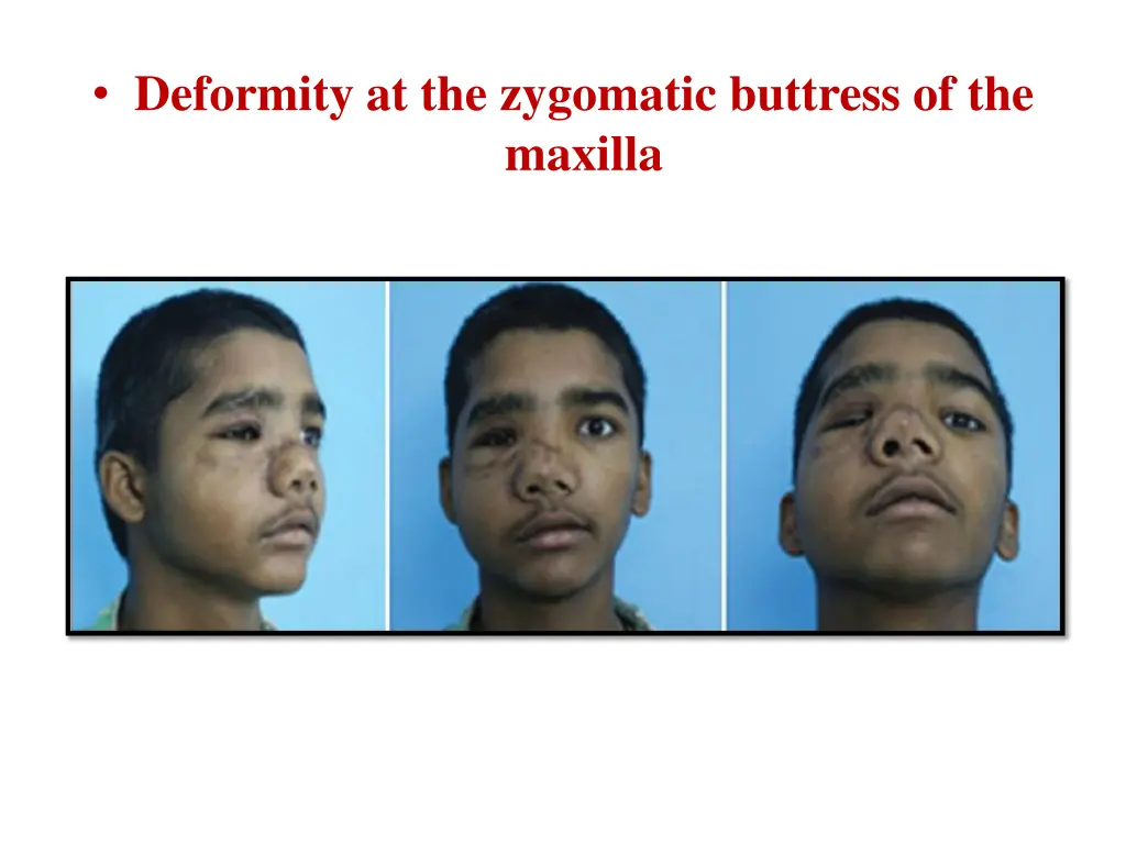 deformity at the zygomatic buttress of the maxilla