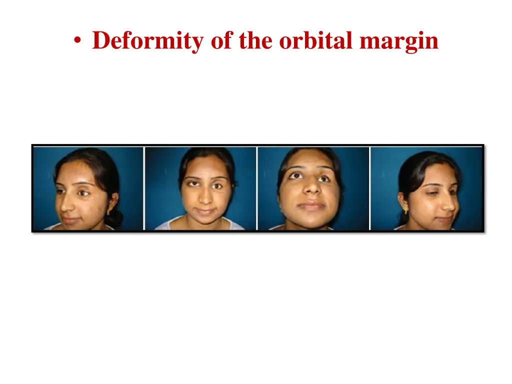 deformity of the orbital margin