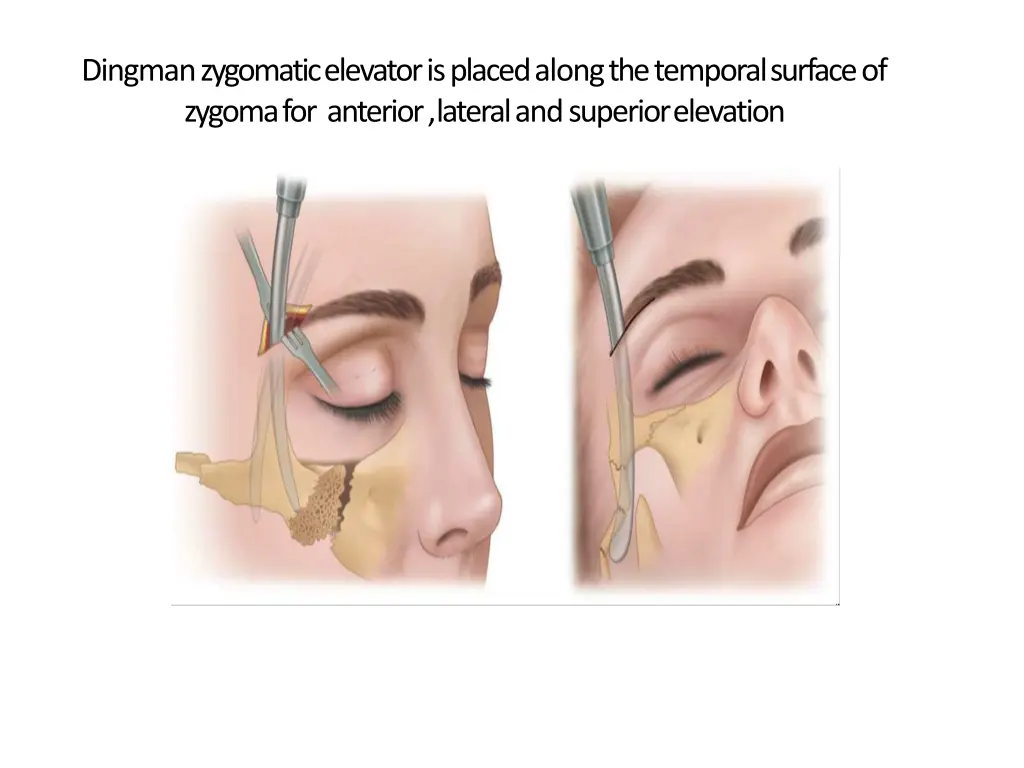 dingmanzygomaticelevatorisplacedalongthetemporalsu