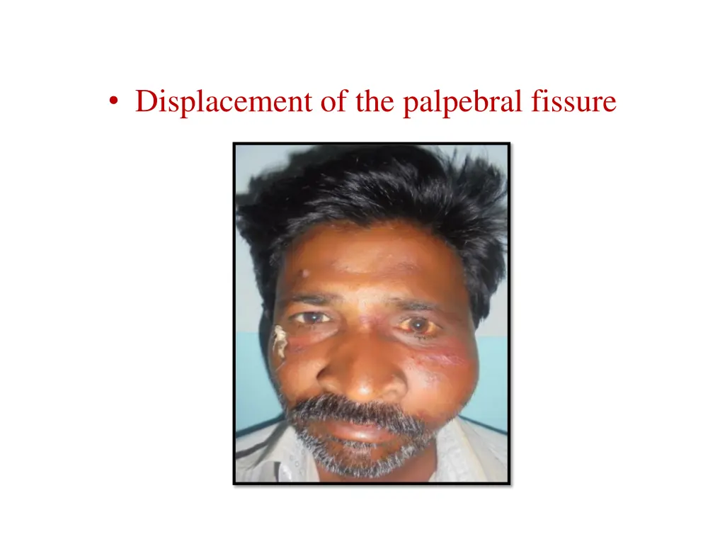 displacement of the palpebral fissure