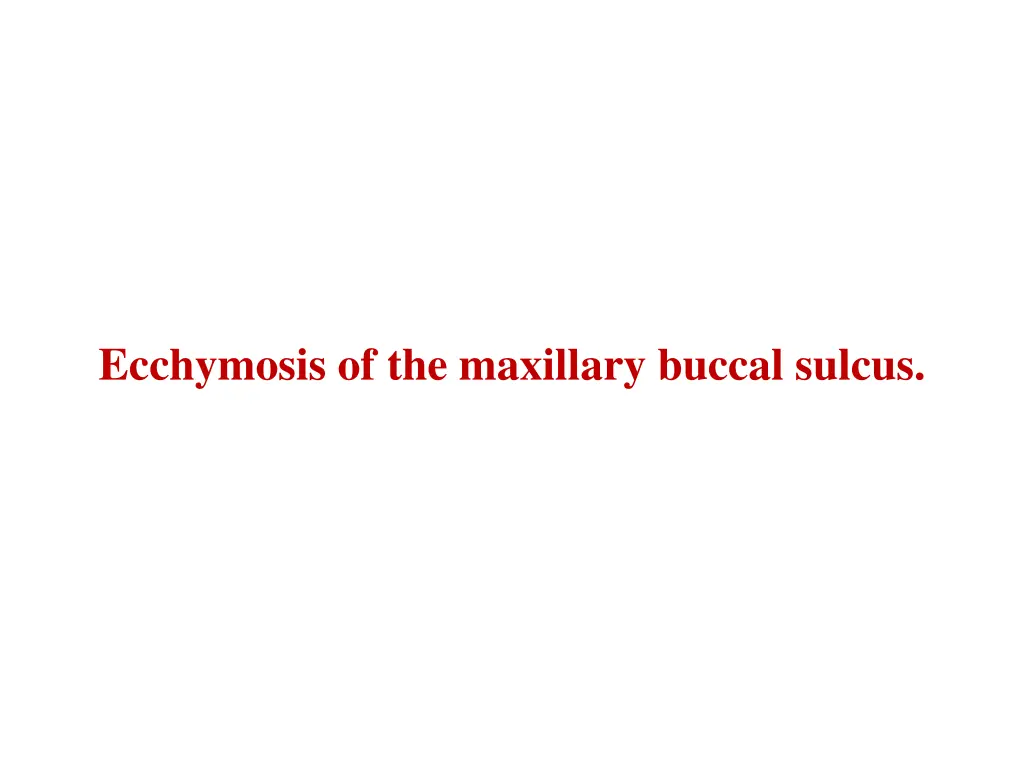 ecchymosis of the maxillary buccal sulcus