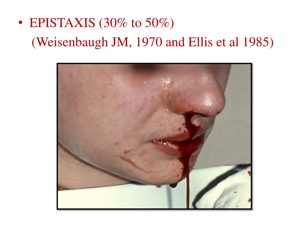 epistaxis 30 to 50 weisenbaugh jm 1970 and ellis