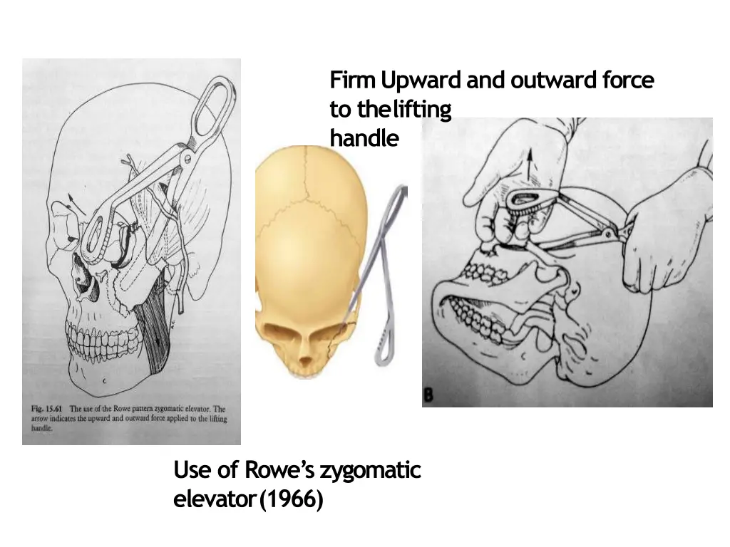 firm upward and outward force to thelifting handle