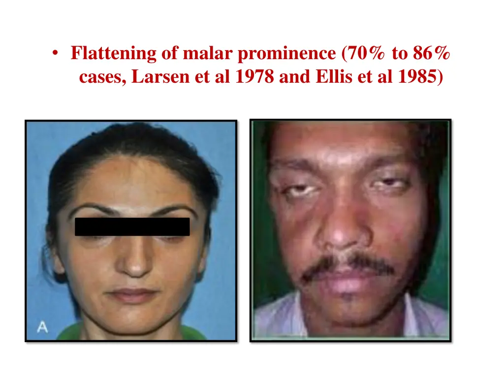 flattening of malar prominence 70 to 86 cases