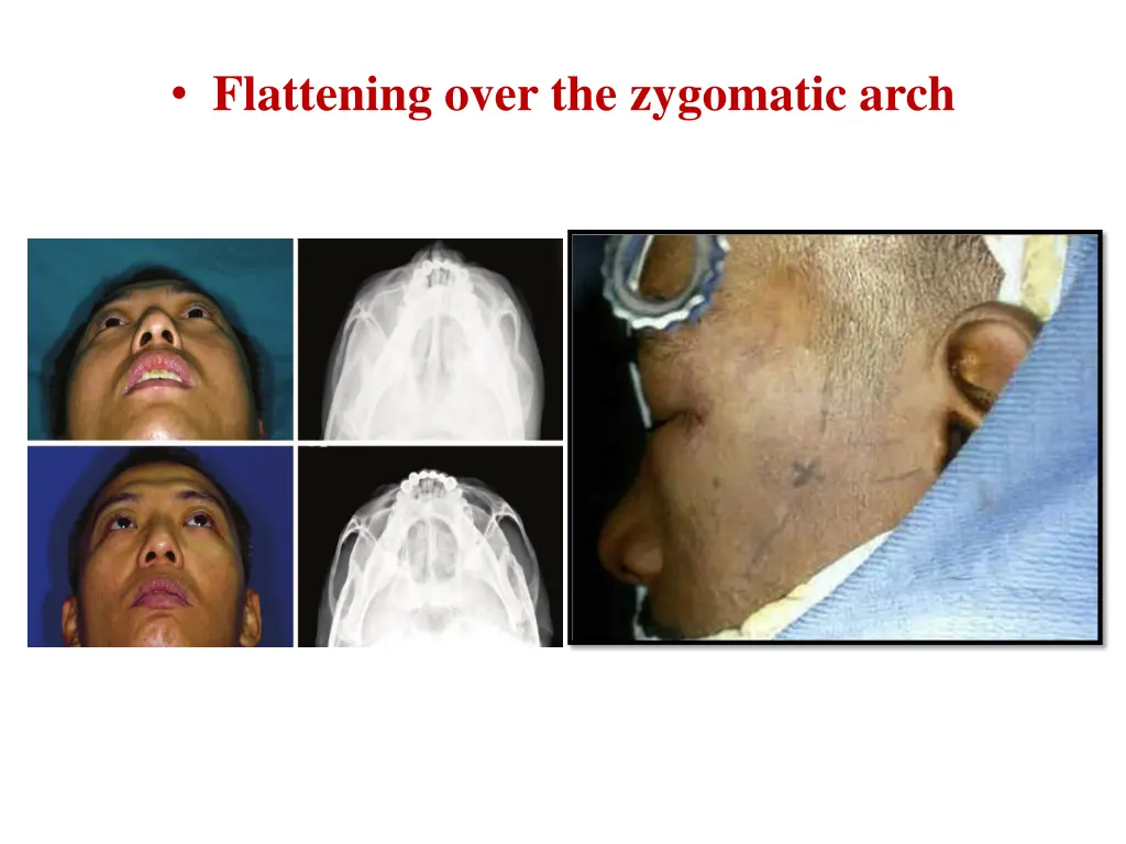 flattening over the zygomatic arch