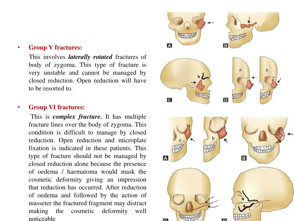 group v fractures