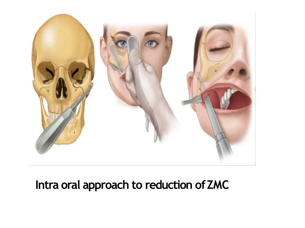 intra oral approach to reduction ofzmc