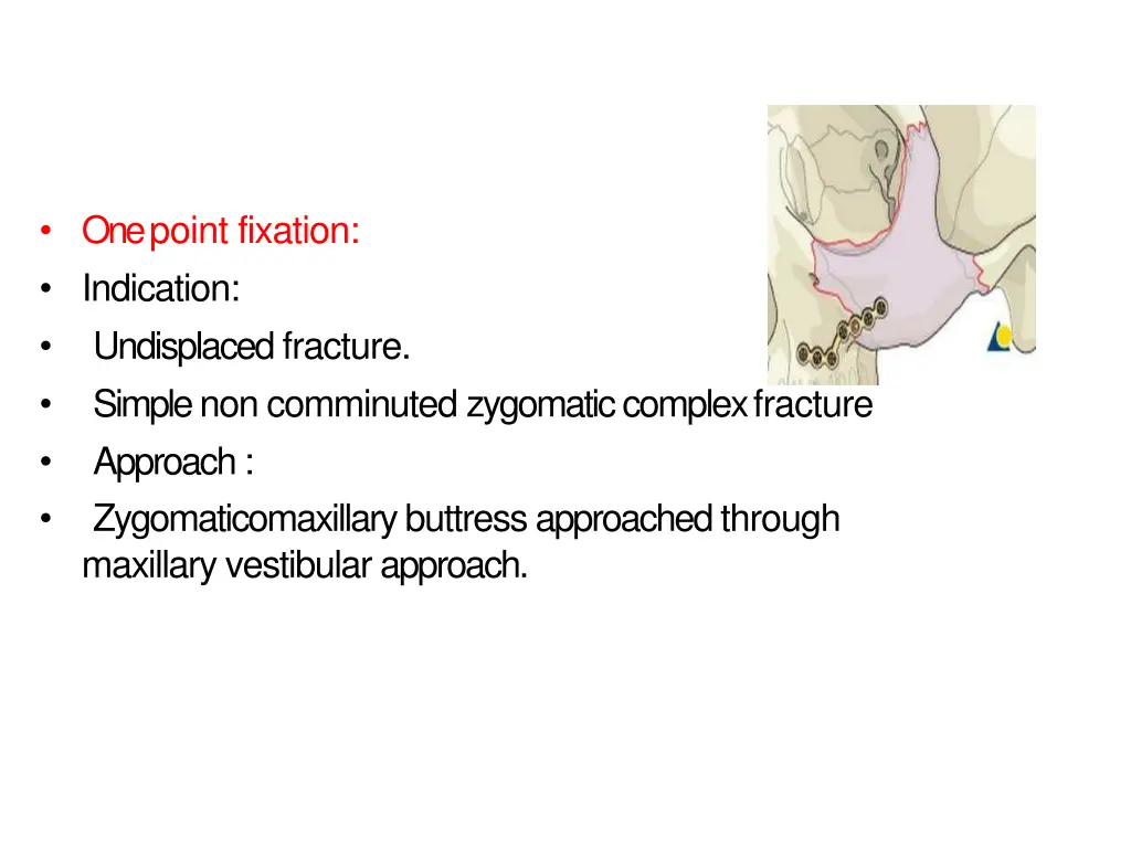 one point fixation indication undisplacedfracture