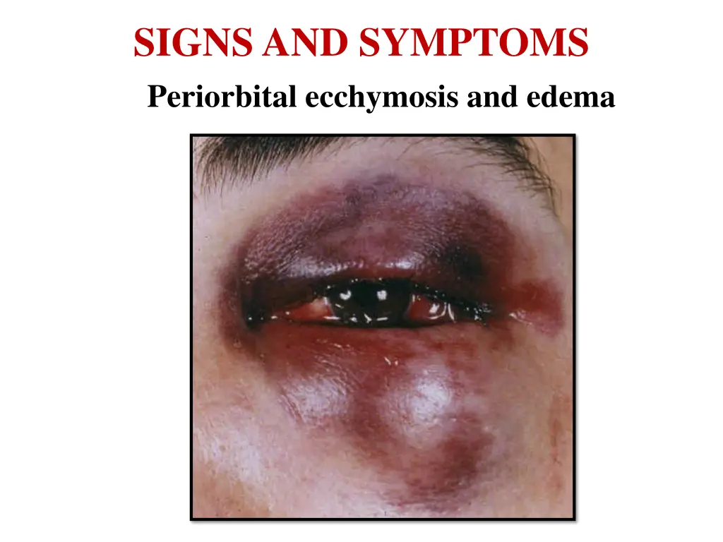 signs and symptoms periorbital ecchymosis