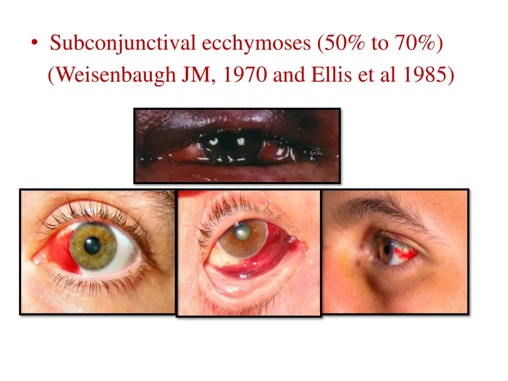 subconjunctival ecchymoses 50 to 70 weisenbaugh