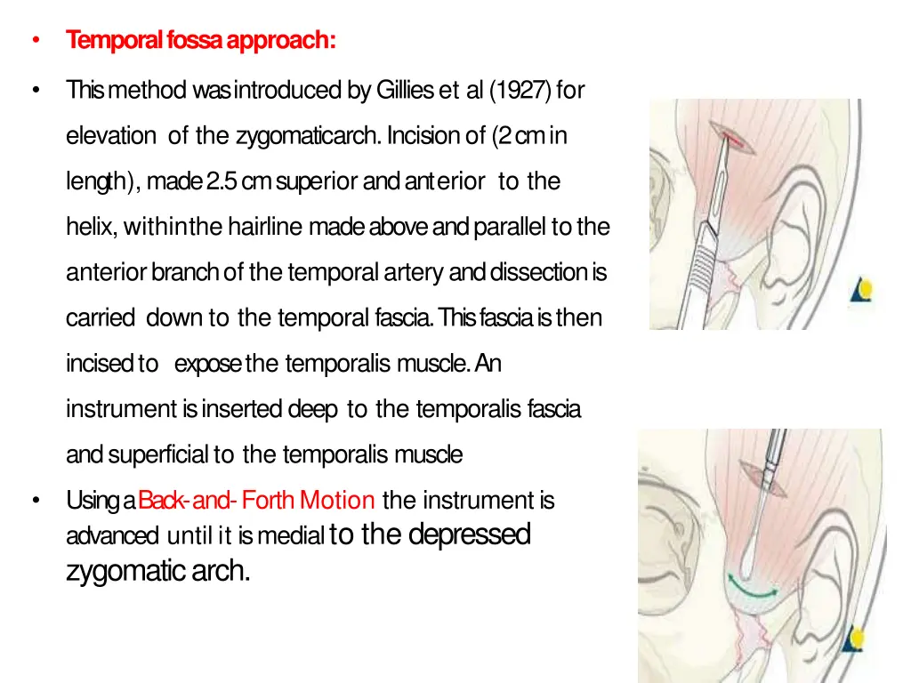 temporal fossaapproach