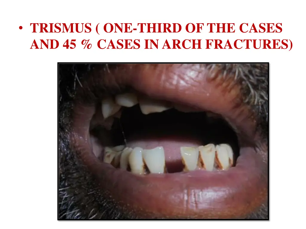 trismus one third of the cases and 45 cases