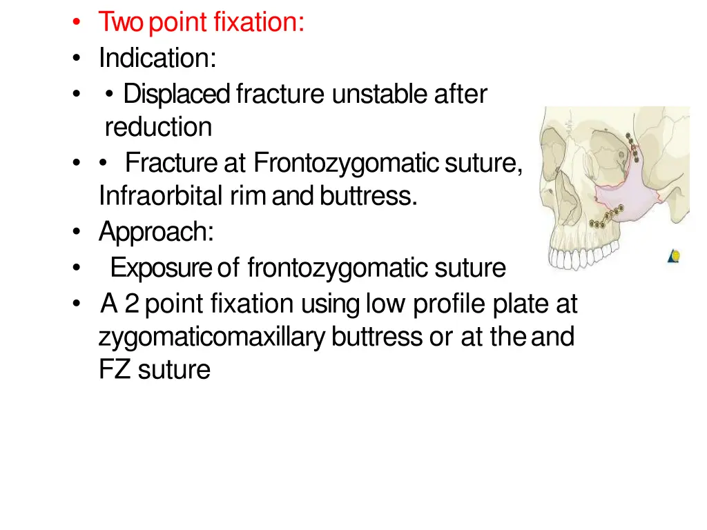 two point fixation indication displaced fracture