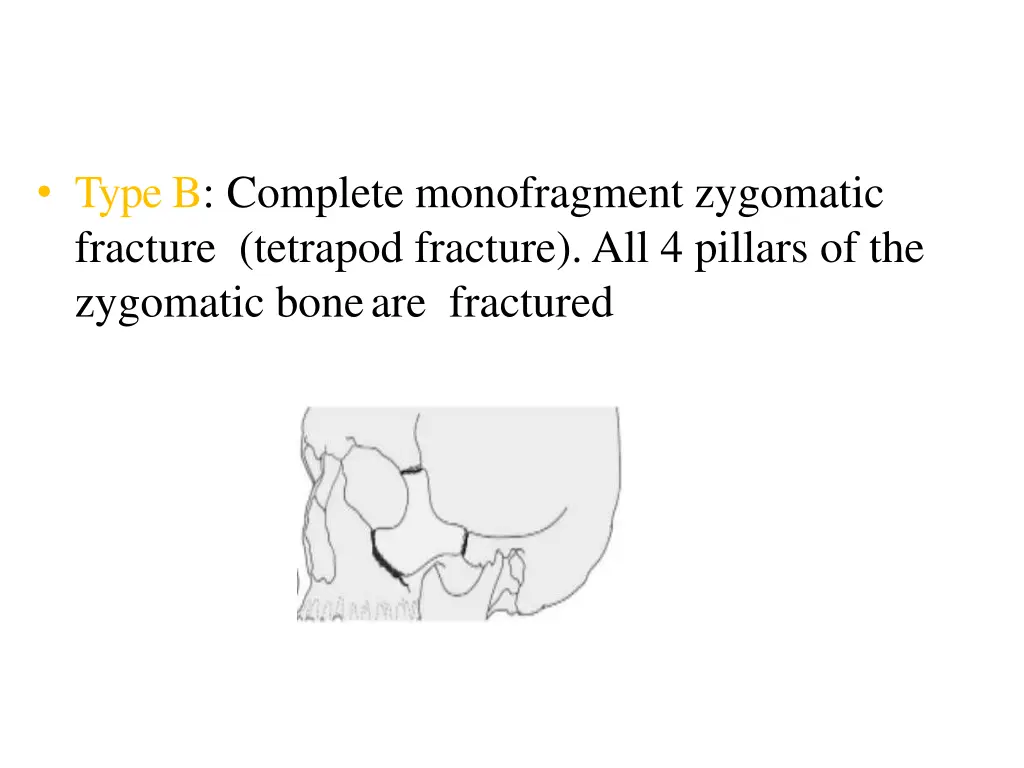 type b complete monofragment zygomatic fracture