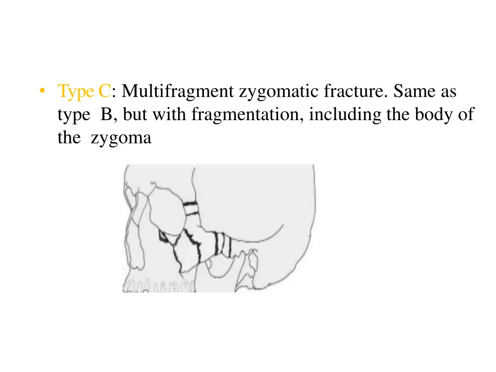 type c multifragment zygomatic fracture same