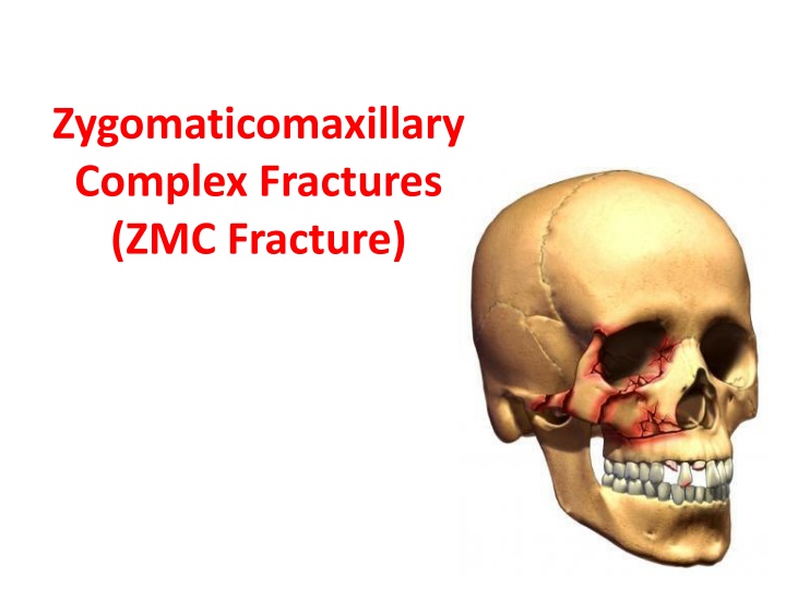 zygomaticomaxillary complex fractures zmc fracture