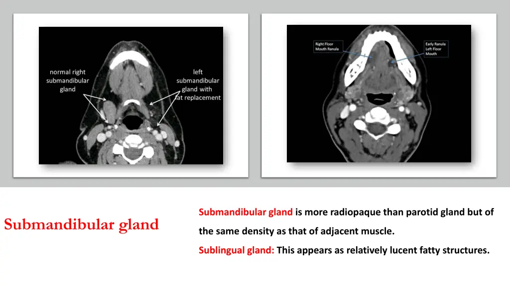 submandibular gland is more radiopaque than