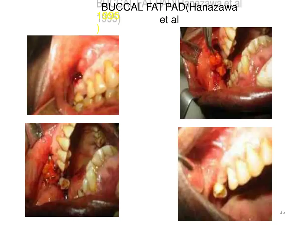 buccal fat pad hanazawa et al