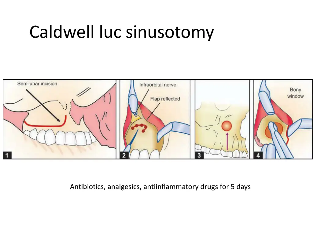 caldwell luc sinusotomy