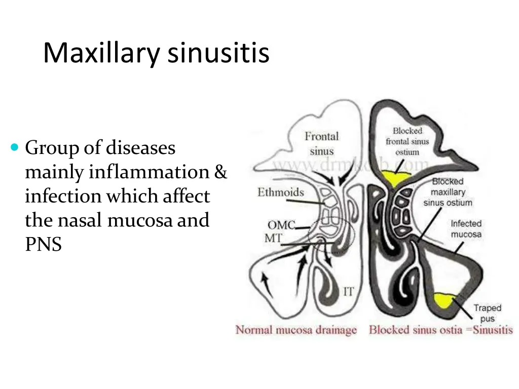 maxillarysinusitis