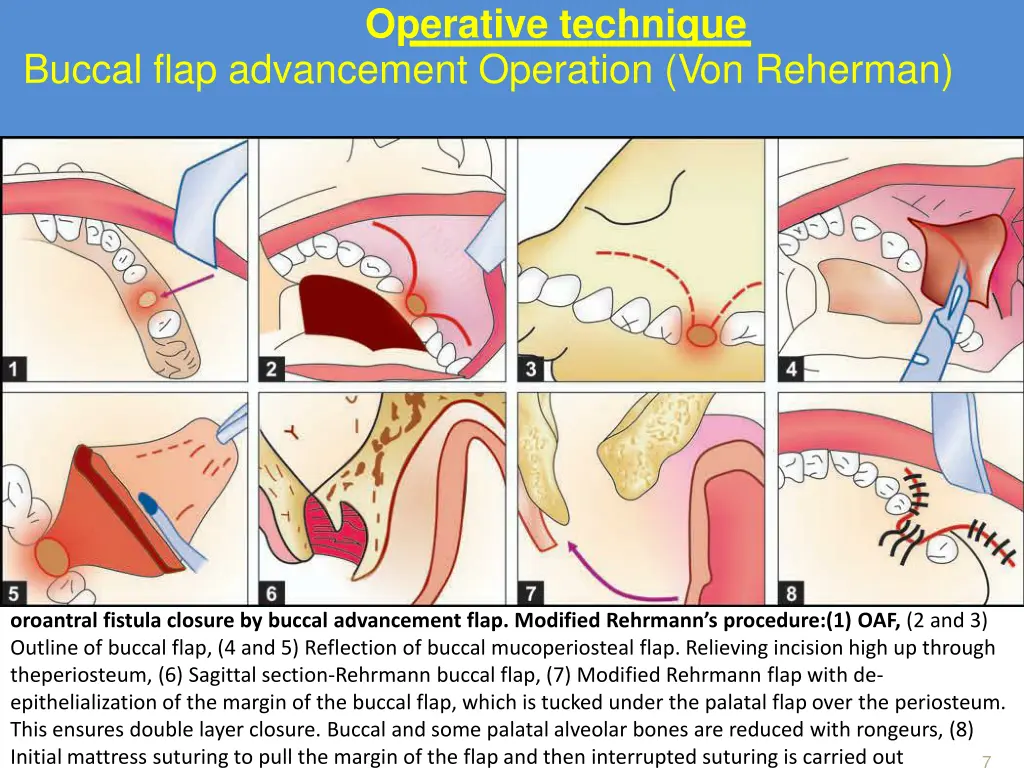 operative technique