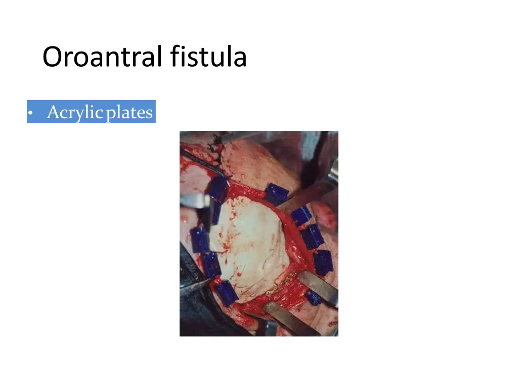 oroantral fistula 6