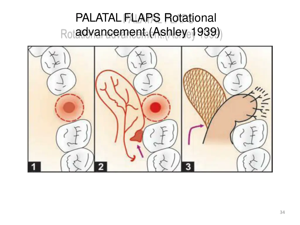 palatalflaps rotational advancement ashley 1939