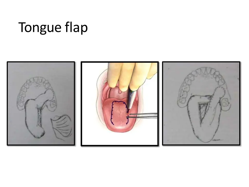 tongueflap