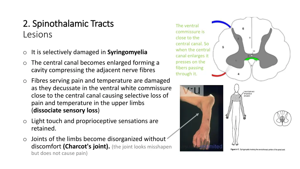 2 spinothalamic tracts 2 spinothalamic tracts