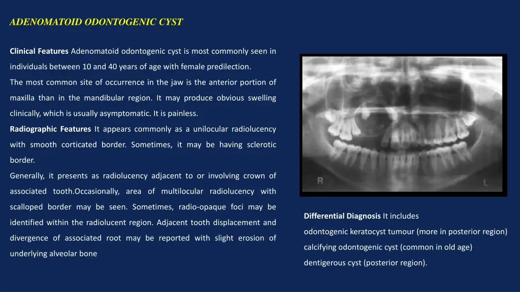 adenomatoid odontogenic cyst