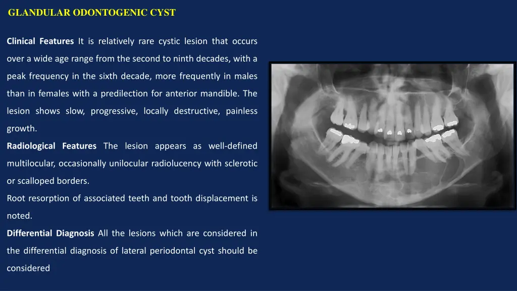 glandular odontogenic cyst