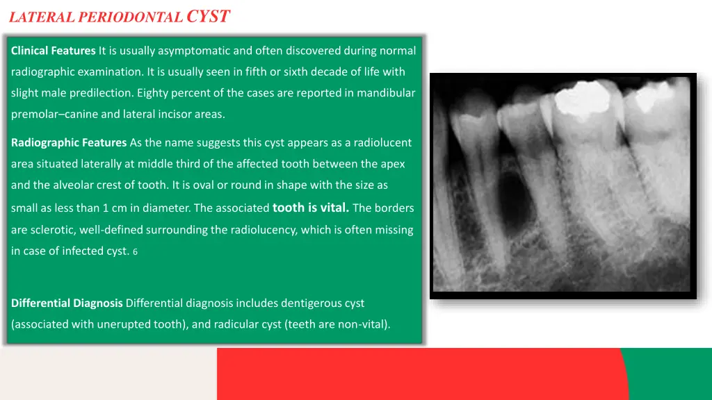 lateral periodontal cyst