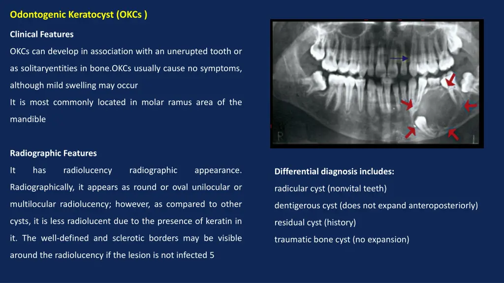 odontogenic keratocyst okcs