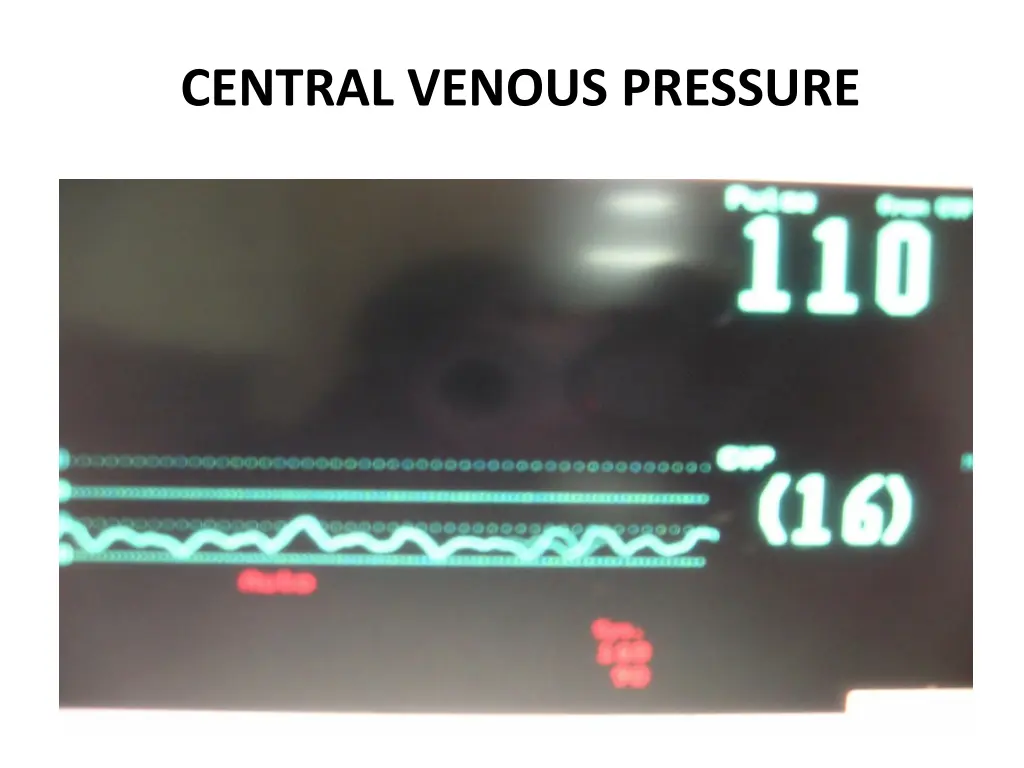 central venous pressure