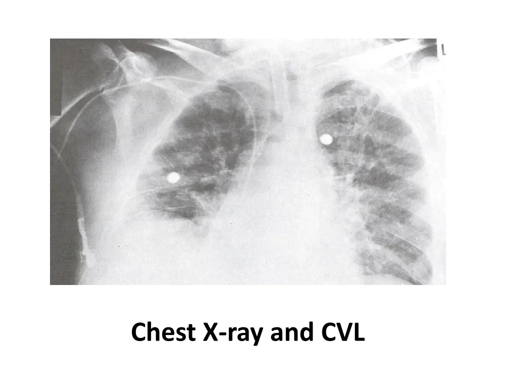 chest x ray and cvl