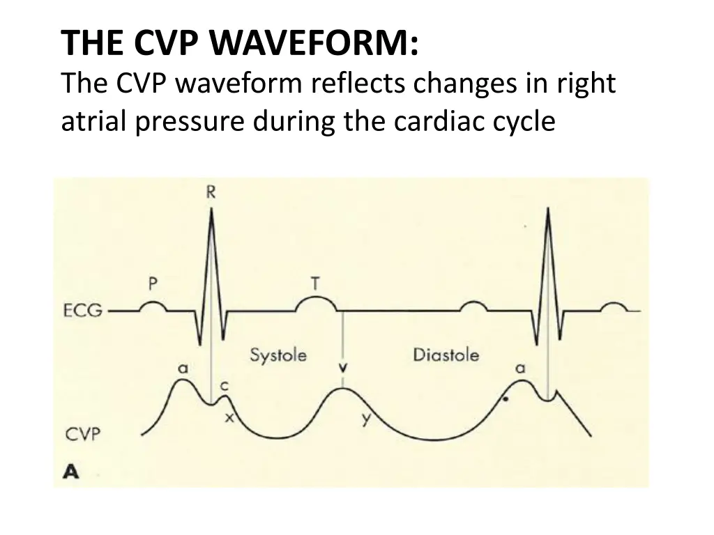 the cvp waveform the cvp waveform reflects