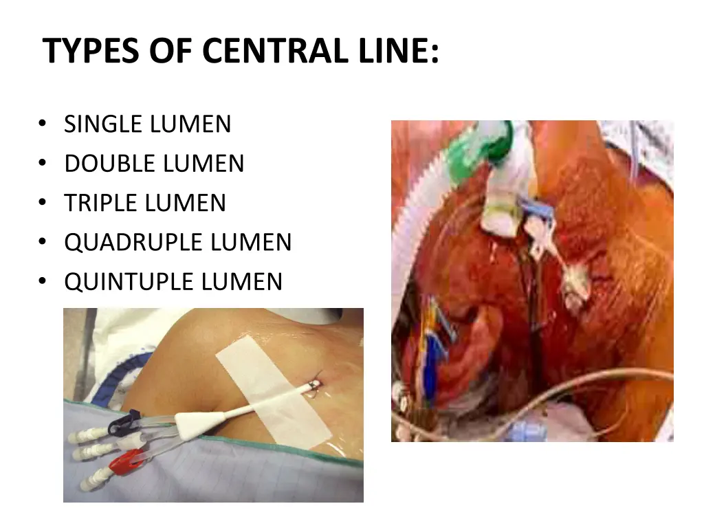 types of central line
